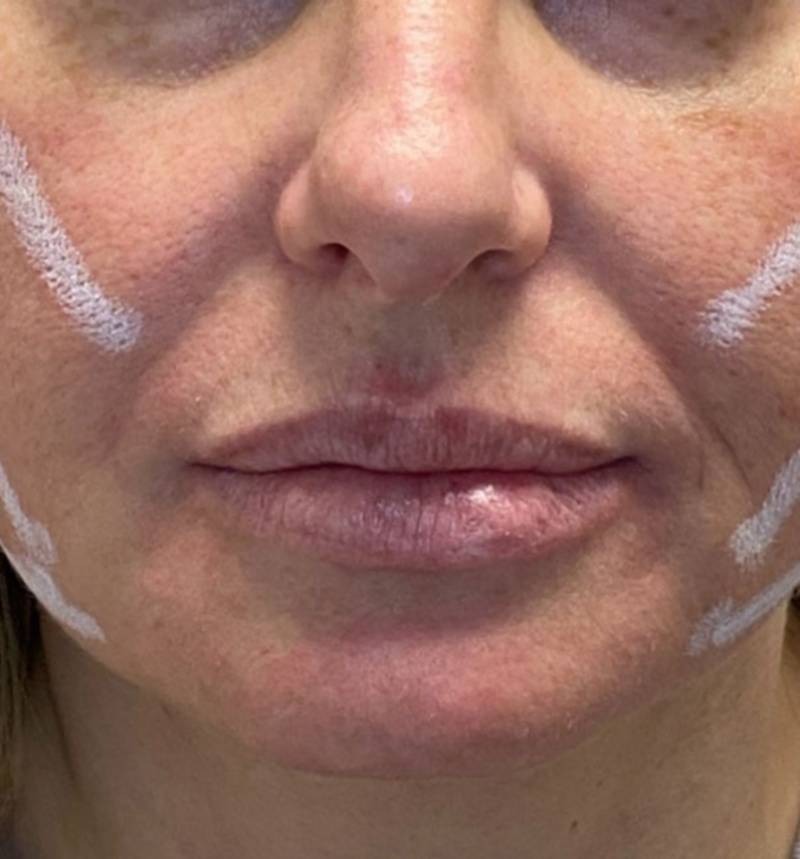 imgi_2_800px_patient2-before-pdo-threadlift-2