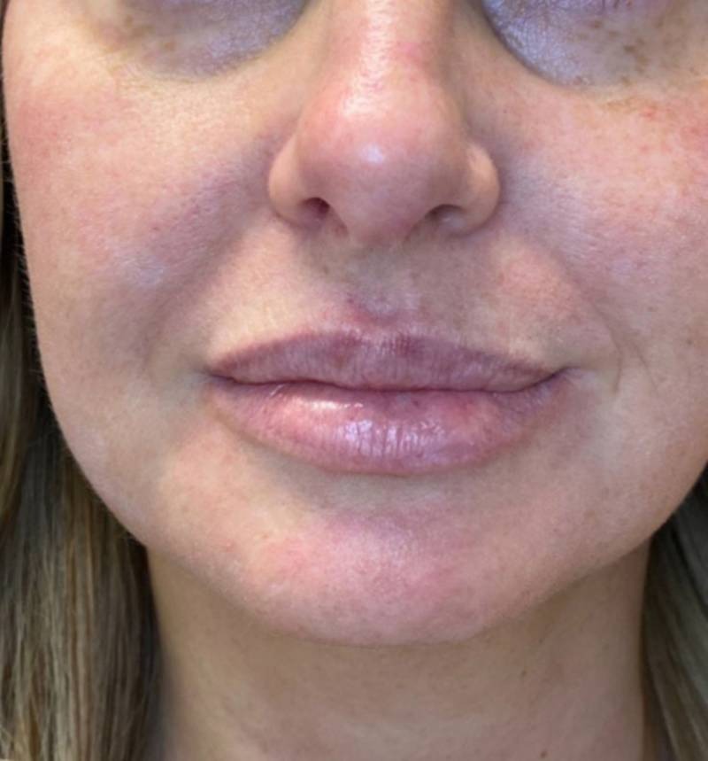 imgi_3_800px_patient2-after-pdo-threadlift-2