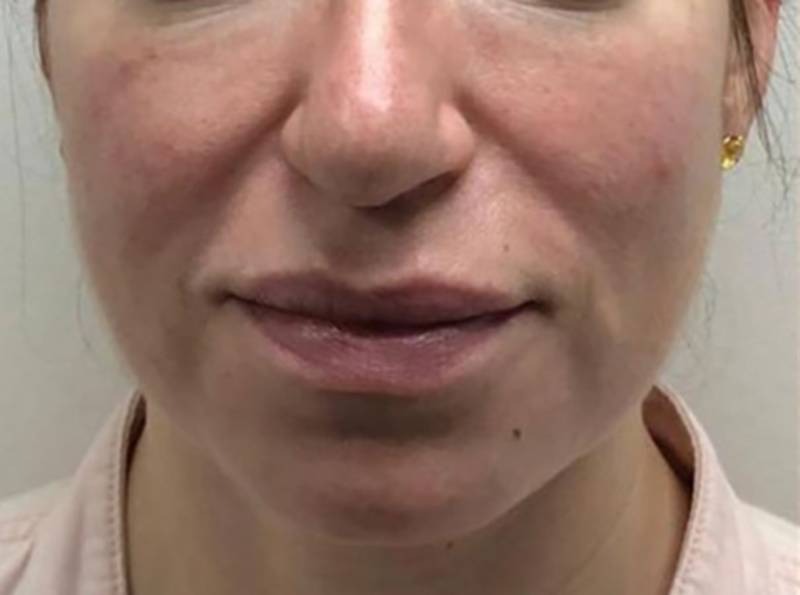 imgi_4_800px_patient1-before-pdo-threadlift-2