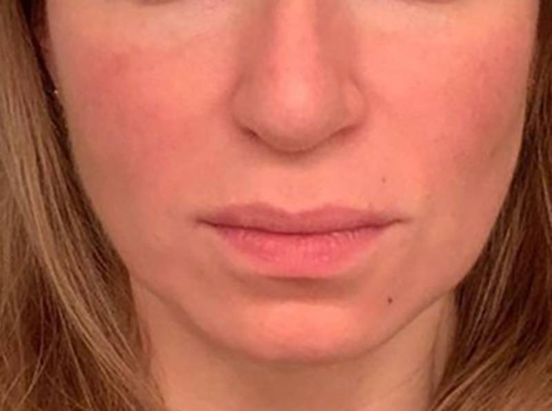 imgi_5_800px_patient1-after-pdo-threadlift-2