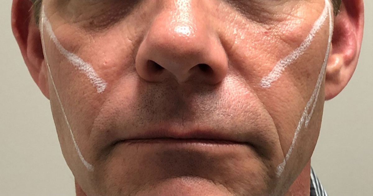 imgi_6_1200px_patient3-before-pdo-threadlift-2