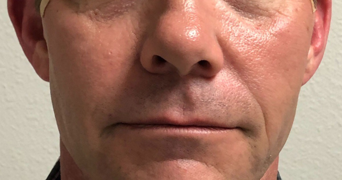 imgi_7_1200px_patient3-after-pdo-threadlift-2